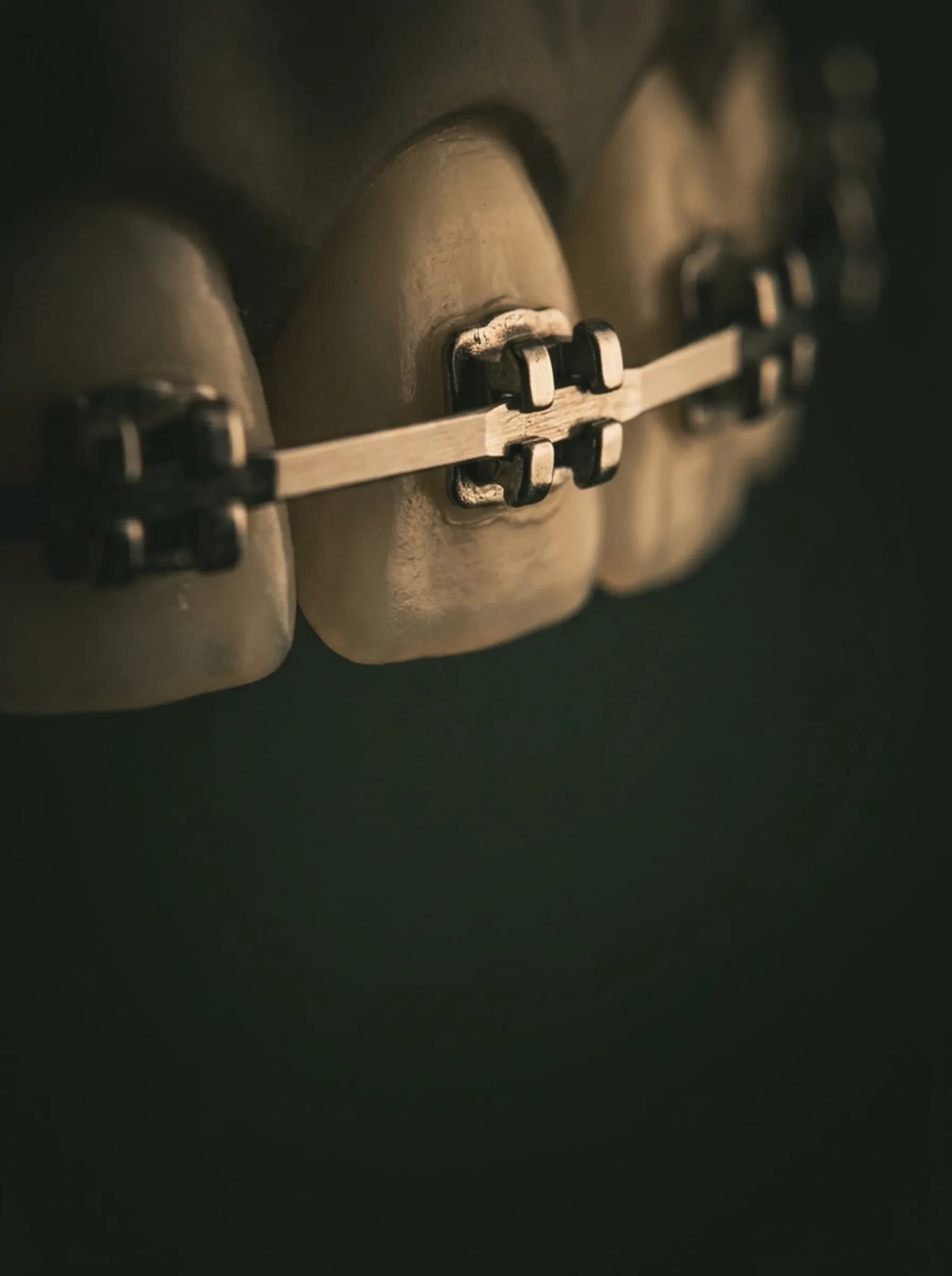 Rectangular archwire engaged in a bracket slot, showing the flat wire cross-section